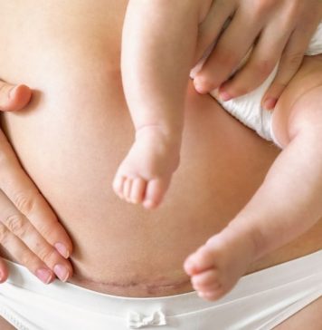 Cesarean Awareness Month: Behind Our Scars